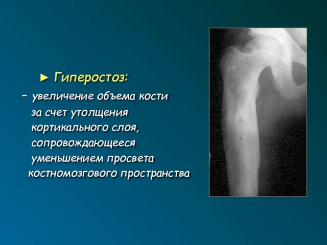 ► Гиперостоз: - увеличение объема кости за счет утолщения кортикального слоя, сопровождающееся уменьшением просвета костномозгового пространства
