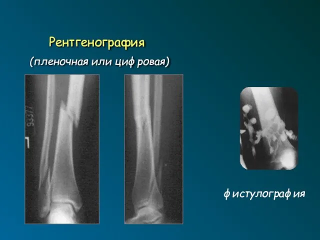 Рентгенография (пленочная или цифровая) фистулография