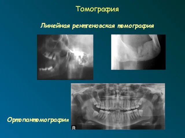 Томография Линейная рентгеновская томография Ортопантомография