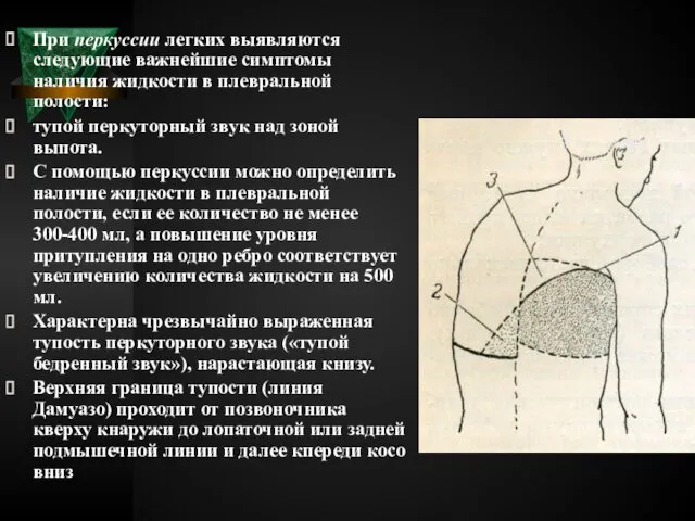 При перкуссии легких выявляются следующие важнейшие симптомы наличия жидкости в плевральной