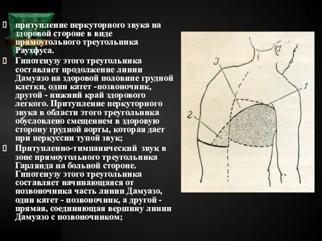 притупление перкуторного звука на здоровой стороне в виде прямоугольного треугольника Раухфуса.