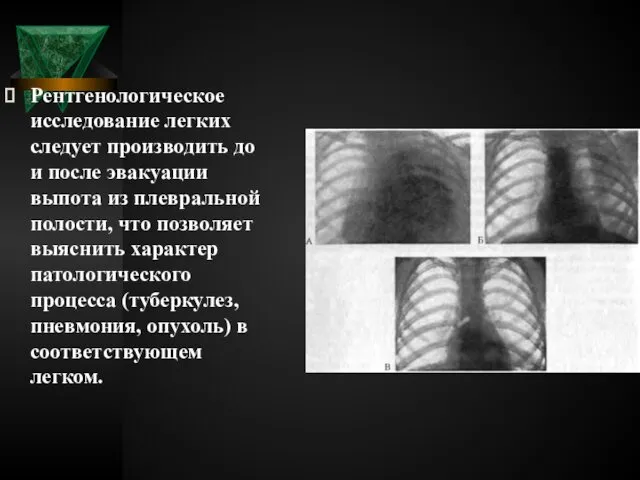 Рентгенологическое исследование легких следует производить до и после эвакуации выпота из