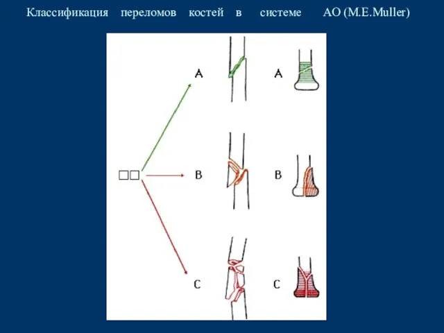 Классификация переломов костей в системе АО (M.E.Muller)