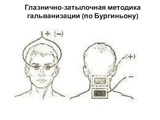 Глазнично-затылочная методика гальванизации (по Бургиньону)