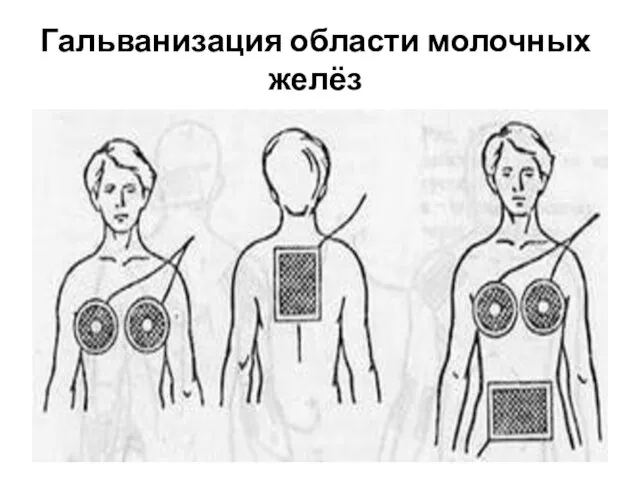 Гальванизация области молочных желёз