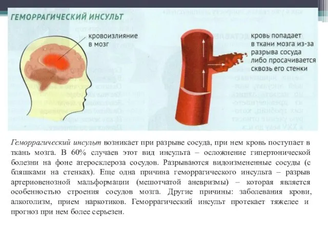 Геморрагический инсульт возникает при разрыве сосуда, при нем кровь поступает в