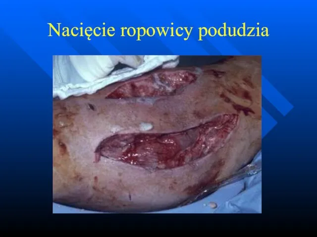 Nacięcie ropowicy podudzia