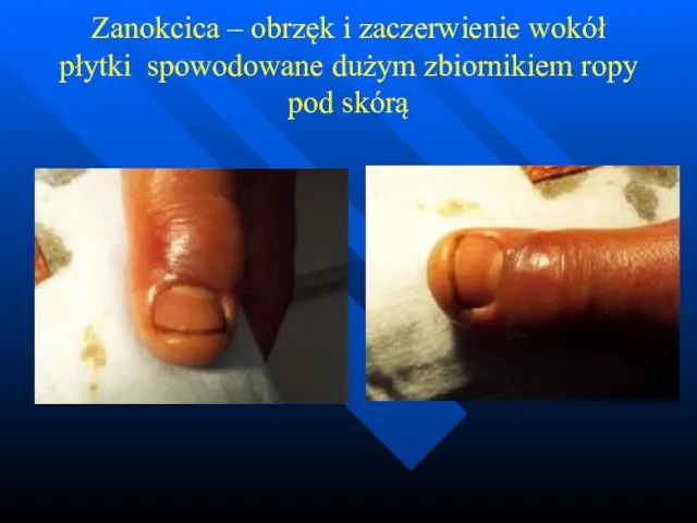 Zanokcica – obrzęk i zaczerwienie wokół płytki spowodowane dużym zbiornikiem ropy pod skórą