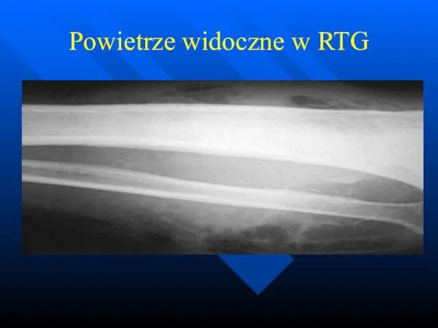 Powietrze widoczne w RTG