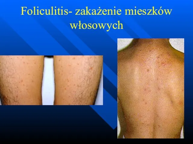 Foliculitis- zakażenie mieszków włosowych