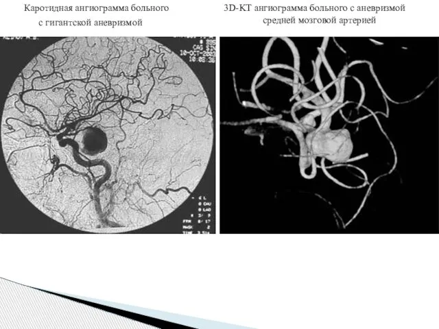 Каротидная ангиограмма больного с гигантской аневризмой 3D-KT ангиограмма больного с аневризмой средней мозговой артерией