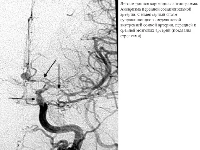 Левосторонняя каротидная ангиограмма. Аневризма передней соединительной артерии. Сегментарный спазм супраклиноидного отдела