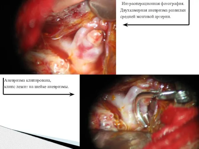 Интраоперационная фотография. Двухкамерная аневризма развилки средней мозговой артерии. Аневризма клипирована, клипс лежит на шейке аневризмы.