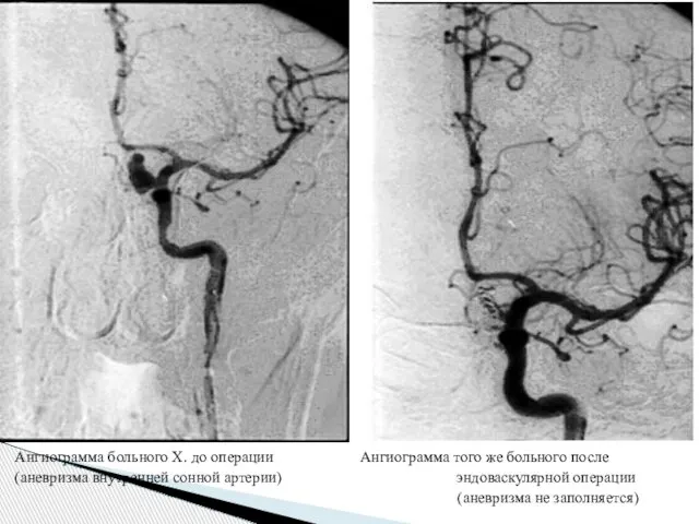 Ангиограмма больного Х. до операции Ангиограмма того же больного после (аневризма