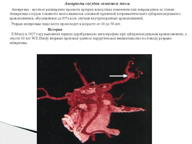 Аневризма сосудов головного мозга Аневризма - местное расширение просвета артерии вследствие