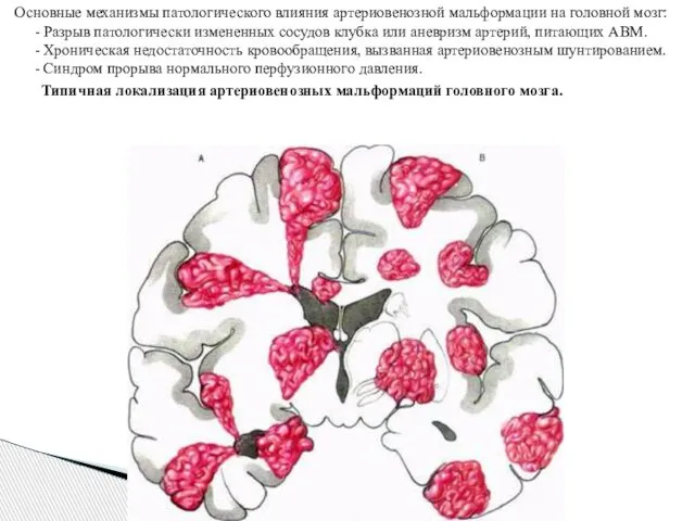 Основные механизмы патологического влияния артериовенозной мальформации на головной мозг: - Разрыв