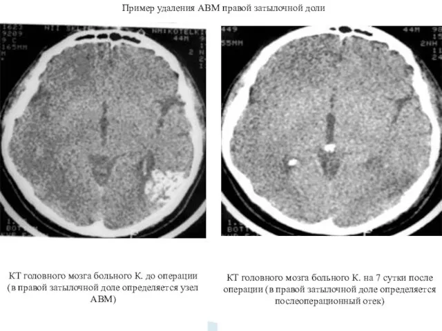 Пример удаления АВМ правой затылочной доли КТ головного мозга больного К.