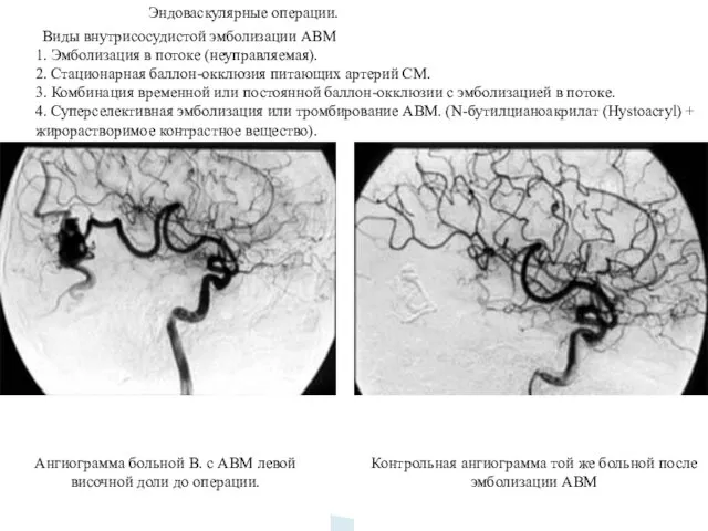 Эндоваскулярные операции. Виды внутрисосудистой эмболизации АВМ 1. Эмболизация в потоке (неуправляемая).