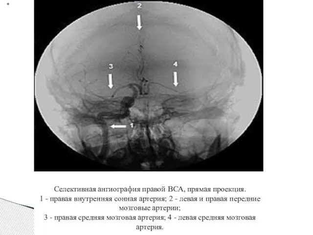 * Селективная ангиография правой ВСА, прямая проекция. 1 - правая внутренняя