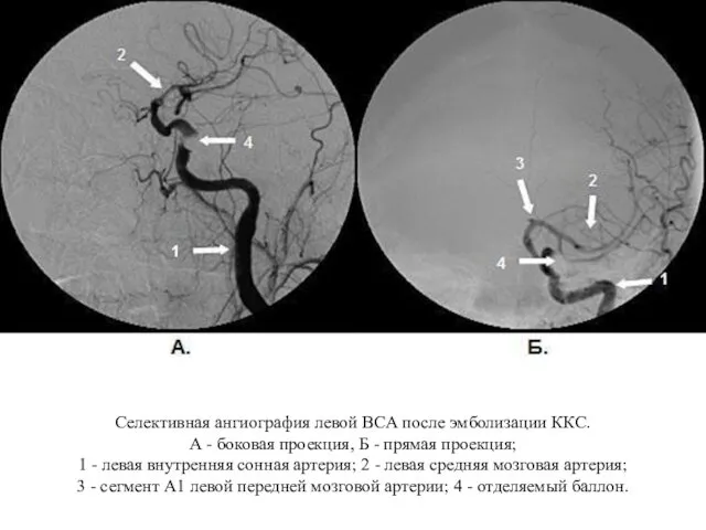 Селективная ангиография левой ВСА после эмболизации ККС. А - боковая проекция,