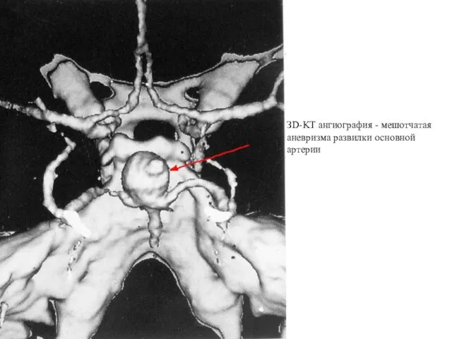 ЗD-KT ангиография - мешотчатая аневризма развилки основной артерии