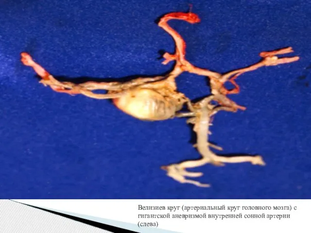 Велизиев круг (артериальный круг головного мозга) с гигантской аневризмой внутренней сонной артерии (слева)