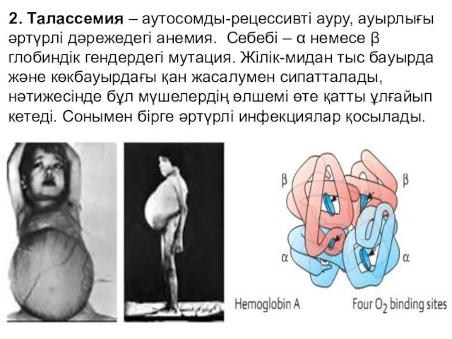 2. Талассемия – аутосомды-рецессивті ауру, ауырлығы әртүрлі дәрежедегі анемия. Себебі –