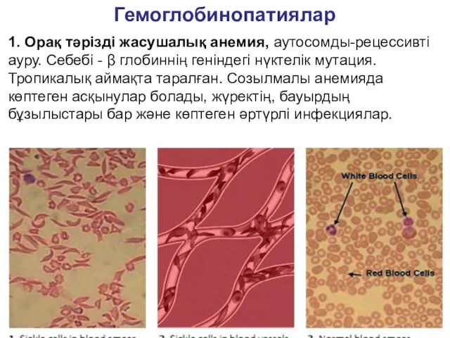 Гемоглобинопатиялар 1. Орақ тәрізді жасушалық анемия, аутосомды-рецессивті ауру. Себебі - β