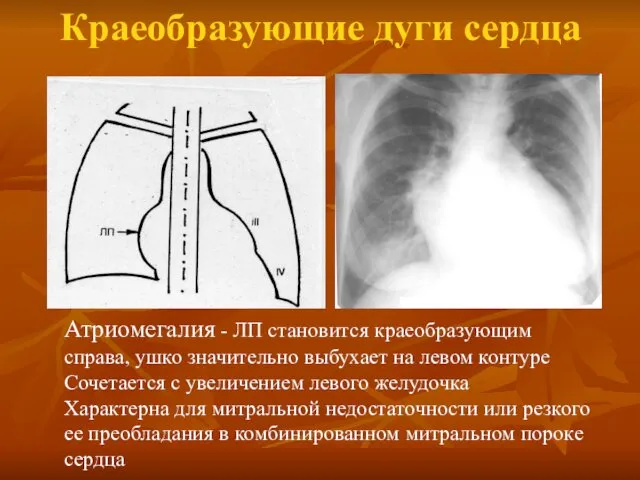 Краеобразующие дуги сердца Атриомегалия - ЛП cтановится краеобразующим справа, ушко значительно