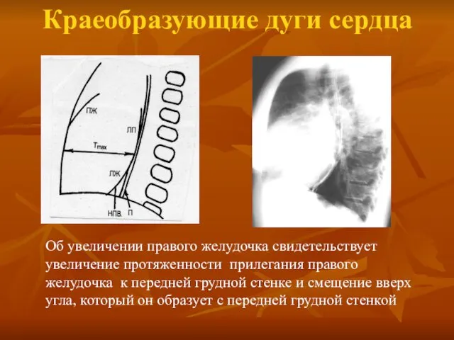 Краеобразующие дуги сердца Об увеличении правого желудочка свидетельствует увеличение протяженности прилегания