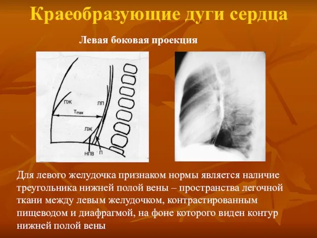 Краеобразующие дуги сердца Для левого желудочка признаком нормы является наличие треугольника