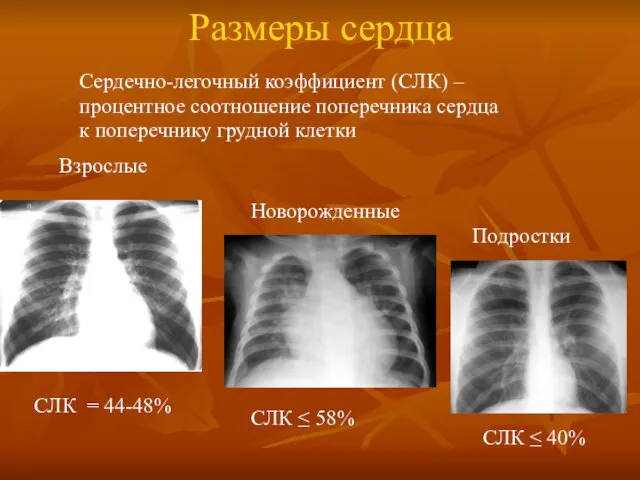 Размеры сердца СЛК = 44-48% Новорожденные СЛК ≤ 58% Подростки СЛК