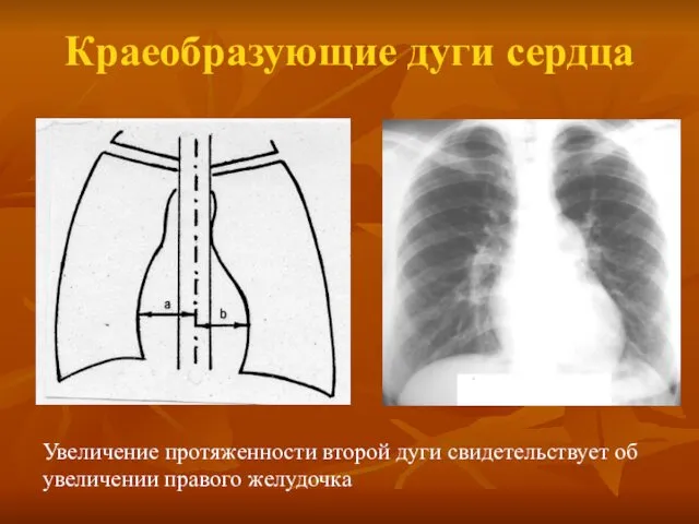 Краеобразующие дуги сердца Увеличение протяженности второй дуги свидетельствует об увеличении правого желудочка