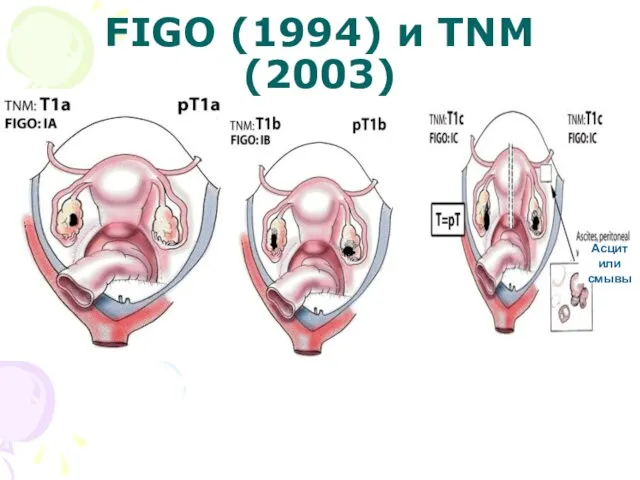 FIGO (1994) и TNM (2003)