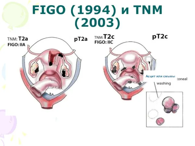 FIGO (1994) и TNM (2003)