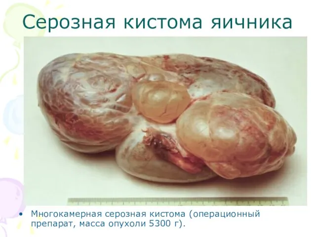 Серозная кистома яичника Многокамерная серозная кистома (операционный препарат, масса опухоли 5300 г).