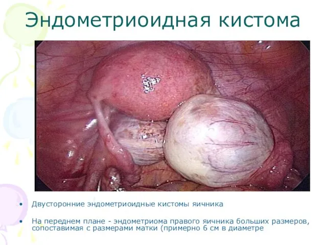 Эндометриоидная кистома Двусторонние эндометриоидные кистомы яичника На переднем плане - эндометриома