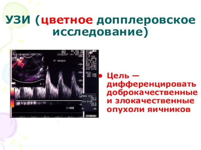 УЗИ (цветное допплеровское исследование) Цель — дифференцировать доброкачественные и злокачественные опухоли яичников