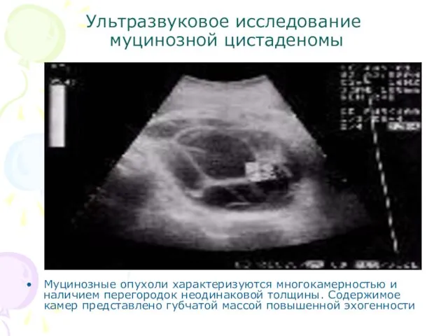 Ультразвуковое исследование муцинозной цистаденомы Муцинозные опухоли характеризуются многокамерностью и наличием перегородок