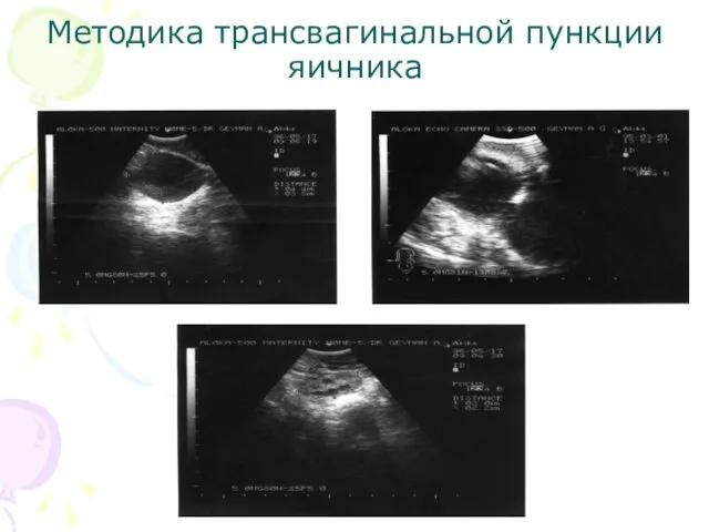 Методика трансвагинальной пункции яичника