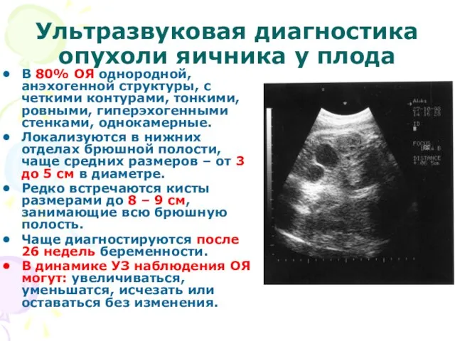 Ультразвуковая диагностика опухоли яичника у плода В 80% ОЯ однородной, анэхогенной