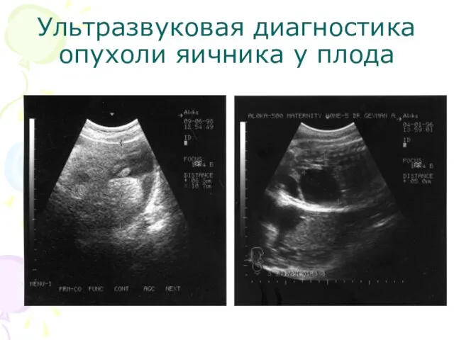 Ультразвуковая диагностика опухоли яичника у плода