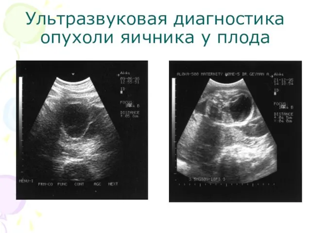 Ультразвуковая диагностика опухоли яичника у плода