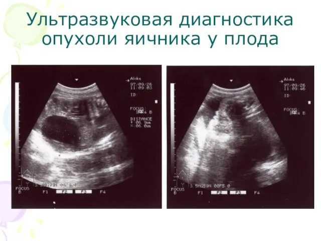 Ультразвуковая диагностика опухоли яичника у плода