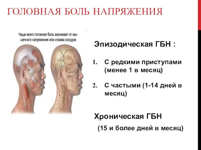 ГОЛОВНАЯ БОЛЬ НАПРЯЖЕНИЯ Эпизодическая ГБН : С редкими приступами (менее 1