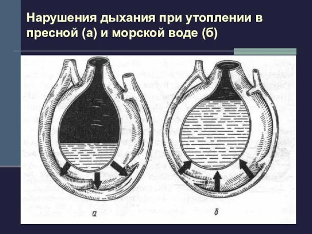 Нарушения дыхания при утоплении в пресной (а) и морской воде (б)