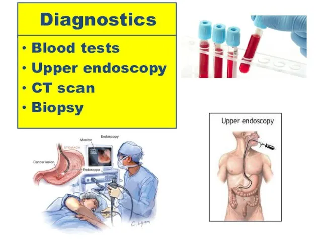 Diagnostics Blood tests Upper endoscopy CT scan Biopsy