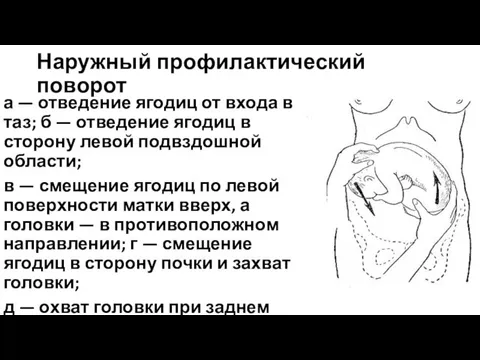 Наружный профилактический поворот а — отведение ягодиц от входа в таз;