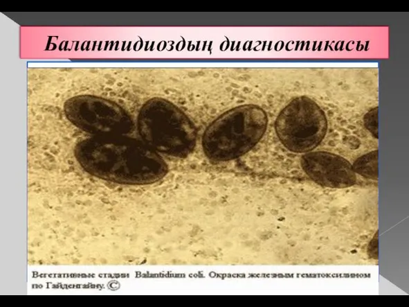 Балантидиоздың диагностикасы Микроскопия мазка кала больного. (нативная микроскопия и микроскопия фиксированного