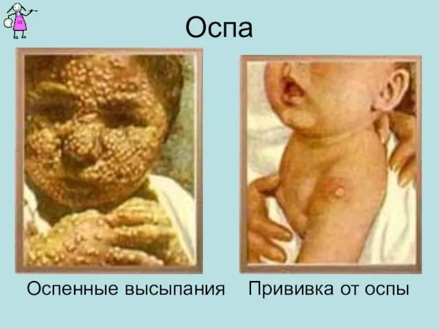 Оспа Оспенные высыпания Прививка от оспы